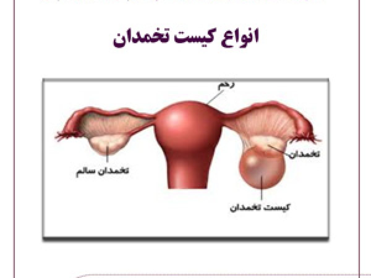 کیست تخمدان