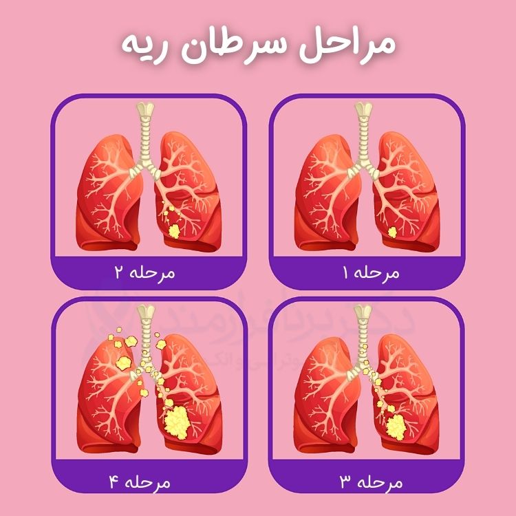 سرطان ریه